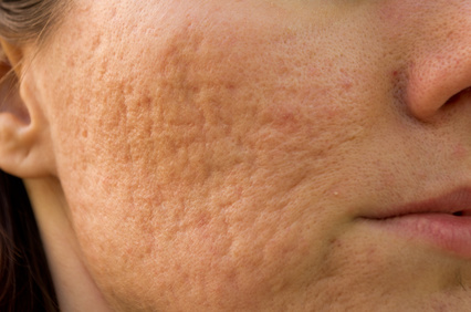 laser resurfacing for acne scars, laser acne scar removal calgary
