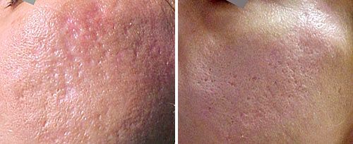 laser acne scar removal calgary, laser acne scar removal, 